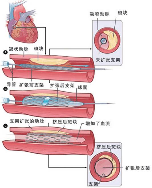 怎样治疗冠心病？(图2)